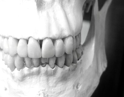 Dental Implants and Jawbone Density Explained