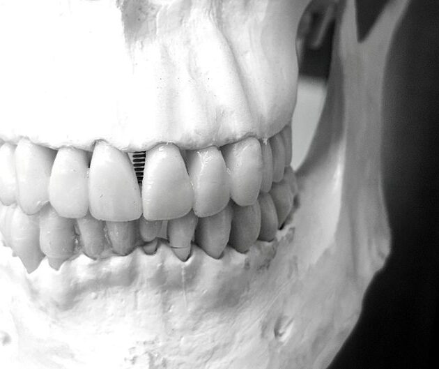 Dental Implants and Jawbone Density Explained