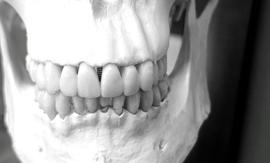 Dental Implants and Jawbone Density Explained