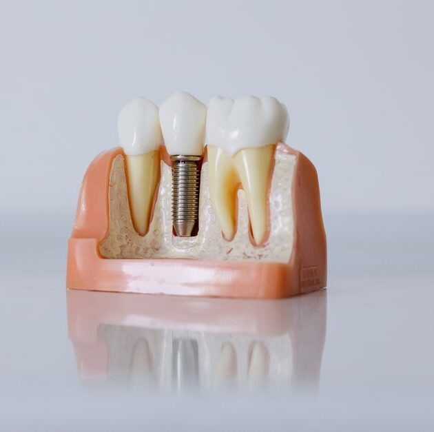 Dental Implant Maintenance for a Lifetime of Use
