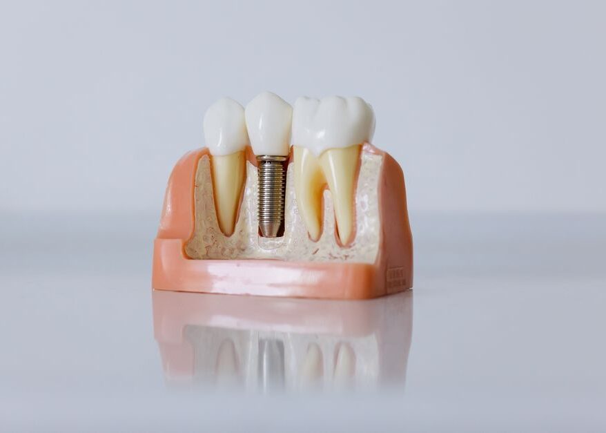 Dental Implant Maintenance for a Lifetime of Use